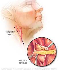 The arteries in neck that supply blood to the brain are called carotid arteries. Carotid Artery Disease Diagnosis And Treatment Mayo Clinic