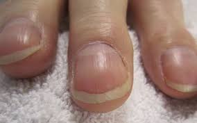 This is not one you yet, overall this type of cancer is rare in the foot. Subungual Melanoma Causes Diagnosis And Treatment