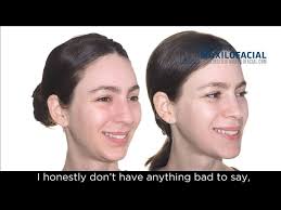 Correction of Small Lower Jaw