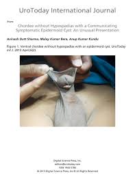 Image result for Chordee