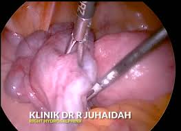 Hemoglobin (hb) adalah protein kaya zat besi dalam sel darah merah yang bertugas membawa oksigen ke seluruh tubuh. Jangkitan Kuman Dr R Juhaidah Blog