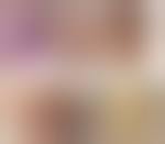 Image result for Syphilis