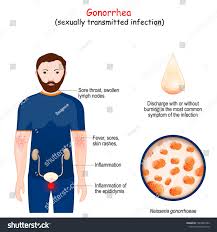 Image result for gonorrhea symptoms