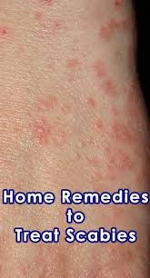 Simple Home Remedies To Treat Scabies Getinfopedia Com Home Remedies For Scabies Scabies Home Remedies