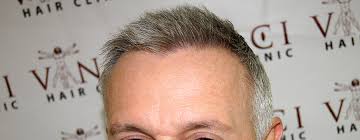 Natural transplants, hair restoration mark follows up with dr. How To Avoid A Bad Hair Transplant Procedure Vinci Hair Transplant