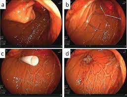 Maybe you would like to learn more about one of these? Endoscopic Findings A The Stomach Wall Is Pushed From Inside The Download Scientific Diagram