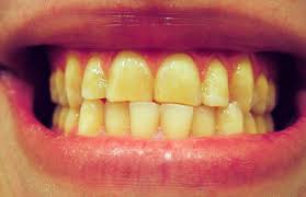 Bruxism Wikipedia
