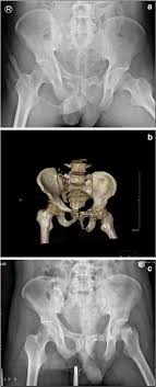 Agreements & disagreements workshop 36. Example Images From The Cases Of Unstable Pelvic Fractures A Xray Download Scientific Diagram