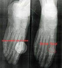 Foot Surgery Confounded By Tos Neurotalk Support Groups Bone Spurs Medical Anatomy Surgery