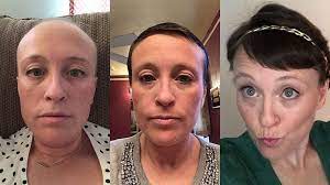 My Chemotherapy Diary 52 Photos Of Hair Loss And Recovery Cancer Hair Loss Chemo Hair Loss Hair Loss