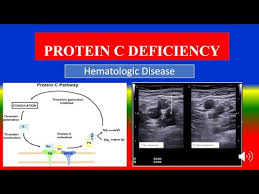 Image result for Protein C Deficiency
