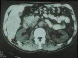 Bauchspeicheldrusenkrebs Was Bedeutet Die Diagnose