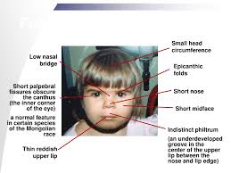 Fellow epicanthal fold owner here :) i'm curious! Ppt Fetal Alcohol Spectrum Disorders Powerpoint Presentation Free Download Id 73560