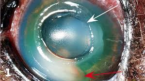 Image result for Hypopyon