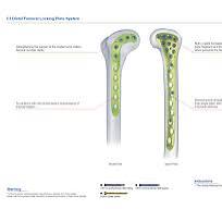 C3 Distal Femoral Locking Plate System,Medical Device ...