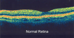 What Conditions Can Oct Help To Diagnose Optical Coherence Tomography Eye Health Ocular