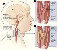 However, pain from carotidynia typically only occurs on one side. Carotid Artery Disease Pacific Stroke Neurovascular Center