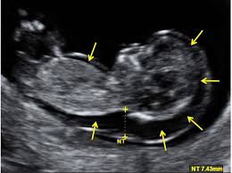 The amount of fluid is measured during an nt ultrasound scan: Increased Fetal Nuchal Translucency Thickness And Normal Karyotype Prenatal And Postnatal Outcome Intechopen