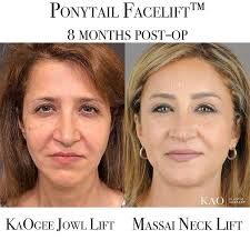 Chia Chi Kao, MD (@kaoplasticsurgery) • Instagram photos and videos