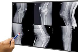 Image result for Fracture XRay