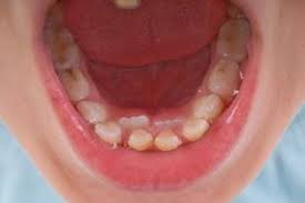 Maybe you would like to learn more about one of these? Mencabut Gigi Anak Yang Berjejal
