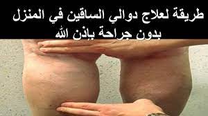 سبب الدوالي و الدوالي السطحية و علاجها | دكتور بيرج. Ø·Ø±ÙŠÙ‚Ø© Ø¹Ø§Ù„Ø¬Øª Ø£Ù…ÙŠ Ø¨Ù‡Ø§ Ù…Ù† Ø¨Ø±ÙˆØ² Ø§Ù„Ø¹Ø±ÙˆÙ‚ ÙˆØ¯ÙˆØ§Ù„ÙŠ Ø§Ù„Ø³Ø§Ù‚ÙŠÙ† Ø¨Ø¯ÙˆÙ† Ø¬Ø±Ø§Ø­Ø© Ø¨Ø£Ù‚Ù„ Ù…Ù† Ø£Ø³Ø¨ÙˆØ¹ Ø¨ÙØ¶Ù„ Ø§Ù„Ù„Ù‡ Youtube
