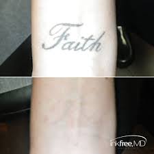 54 learn more about laser tattoo removal today. Pin On Laser Tattoo Removal