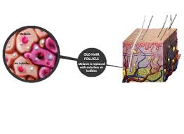 The causes of gray hair can range from your genes, your lifestyle choices, and medical conditions you may hate to break it to you, but some day, you're going to start sprouting white hairs (that is, if you. Remedies To Treat Gray Hair
