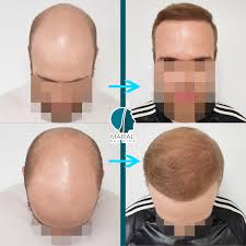 See a doctor who can help Grade 7 8 Hair Loss Maral Hair