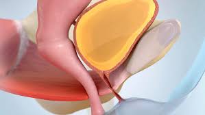 Image result for Urinary Incontinence