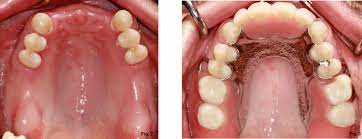 A partial denture replaces one or more teeth, as. Removable Partial Denture For Maxillary Incisors Spear Education