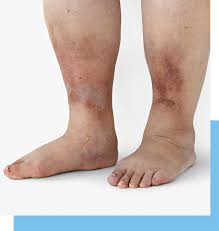 Image result for black toe diabetes