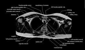 Lower back pain is a pervasive symptom. Chest Anatomy Mri Chest Thorax Axial Anatomy Free Cross Sectional Anatomy