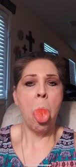 Bee Bite Incident Near Hive