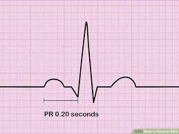 How To Read An Ekg An Interpretation Guide With Sample