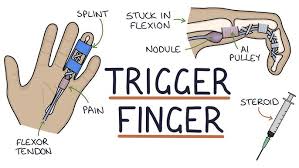Image result for Trigger Finger