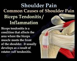 The rotator cuff andwhere the. Shoulder Pain Everything You Need To Know Dr Nabil Ebraheim Youtube