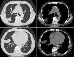 It is important to assess both the quantity of the pleural effusion and severity of the atelectasis. Phantom Tumour Of The Lung Bmj Case Reports