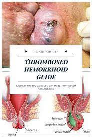 This collateral supply not being sufficient to keep up the proper flow of blood through the part the veins tend to become thrombosed, thus increasing the engorgement. Symptoms Of Thrombosed External Sajjad Piles Clinic Facebook