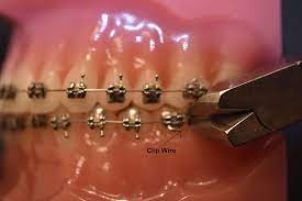 If the wire refuses to move, attempt to cover the end of it with a pinch of wax. Ortho Care From Home Sayre Orthodontics Bozeman Mt