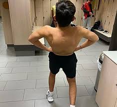 Raps about human a and p muscle. Muscle Atrophy Wikipedia