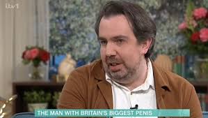 Man goes under brutal three month leg-lengthening process to gain 3 inches