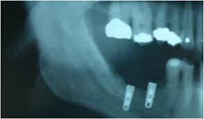Try working with one of our friendly, dental savvy account managers here at dental sky! How To Manage Trigeminal Nerve Injuries In Dentistry Dentistry Today