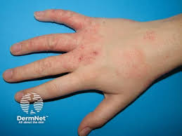 Image result for Hand Dermatitis