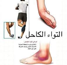 اصابات الانكل فرصة ذهبية لعلاج التواء الكاحل في تركيا توافر علاج التواء الكاحل بتركيا