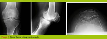 La partie fémorale, la partie tibiale et la partie rotulienne. Les Protheses Du Genou Revue Medicale Suisse