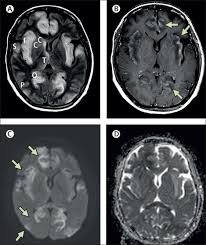 Mri showing extensive necrotizing sequelae. Herpes Simplex Virus Infection Presenting As Stroke Like Symptoms With Atypical Mri Findings The Lancet Infectious Diseases