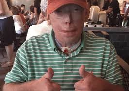 Hero firefighter who saved woman's life undergoes most extensive full face  transplant