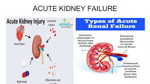 Image result for Postrenal Failure