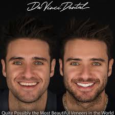 Discover for yourself how a balanced smile can effortlessly transform your  features towards a healthy, youthful glow 🦷✨⁠ -⁠ With "Minimal Drill" and  "Drill Free Veneers", this patient obtained a brand new